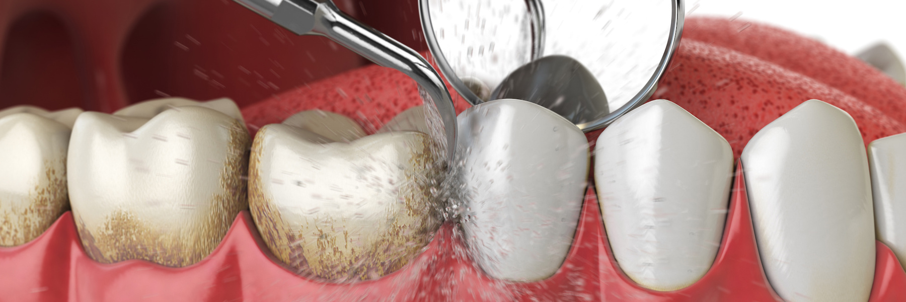 teeth cleaning at Talbert Family Dentistry in Madison, AL