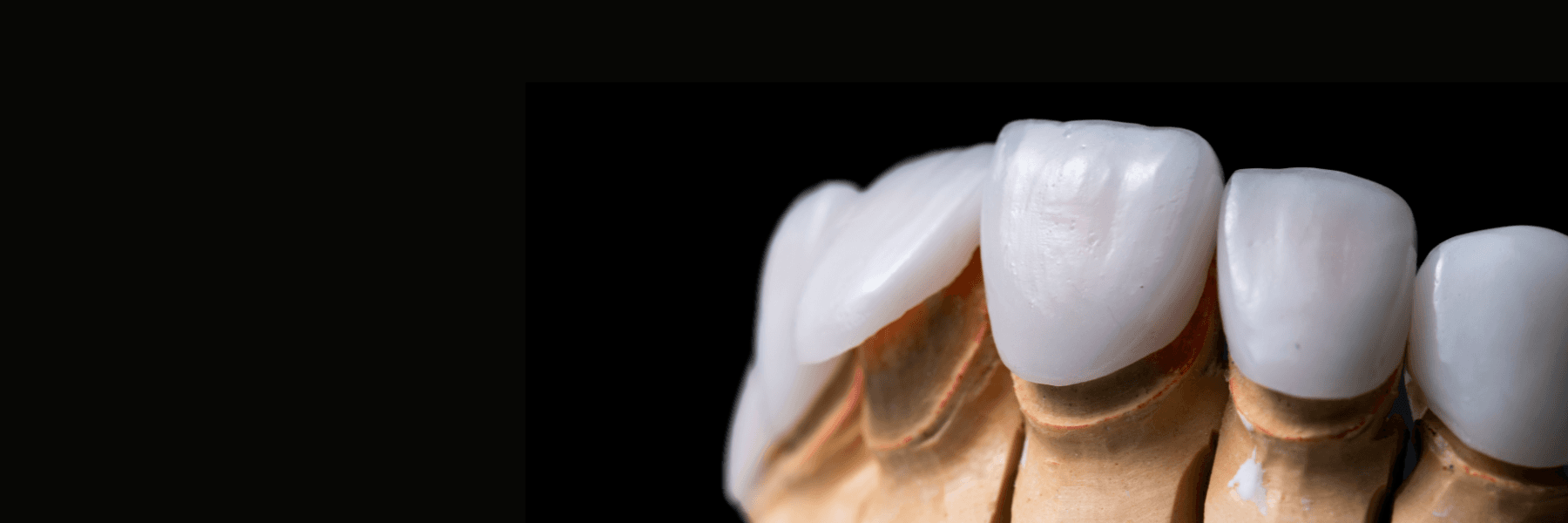 Veneers | Dentist