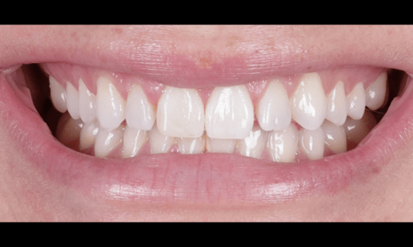 chipped tooth after veneers were placed by dr. talbert in madison
