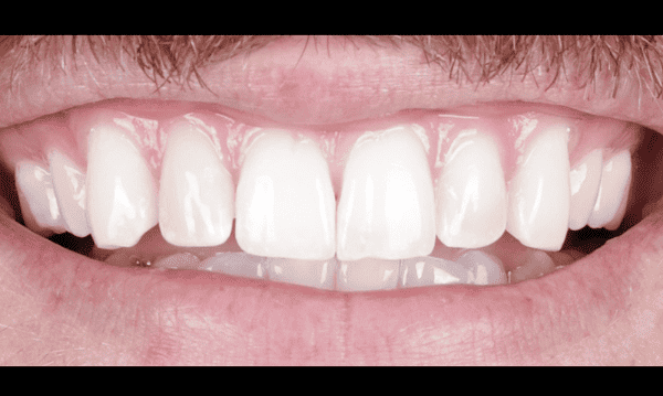 after teeth whitening for front tooth in madison, al