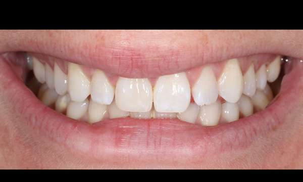 chipped tooth after veneers in madison