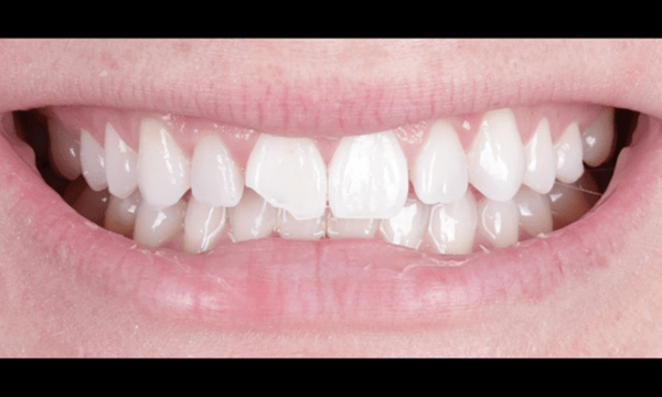 chipped tooth before veneers at talbert family dentistry