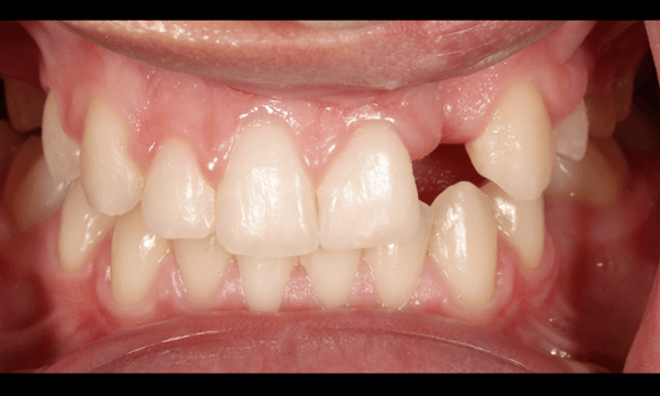 missing tooth before tooth replacement in madison, al