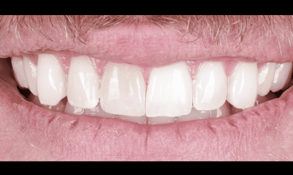 before teeth whitening for front tooth in madison, al