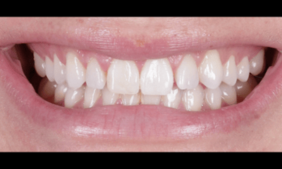 After treatment - Fixed Chipped Tooth with Composite Veneers