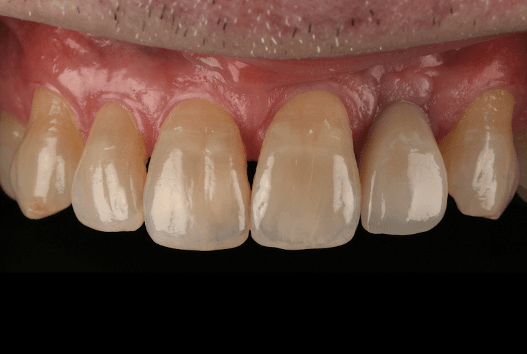 Implant-Crown-After-Image