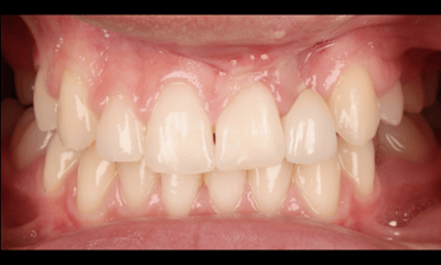 After treatment - Maryland Bridge