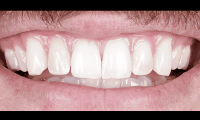 after teeth whitening for front tooth in madison, al