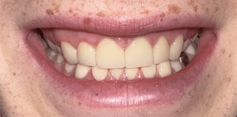 Veneers-After-Image