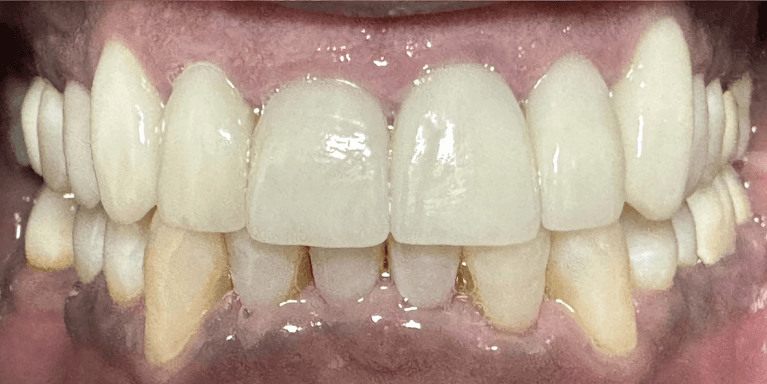 Veneers-After-Image