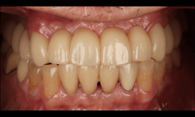 After treatment - Before and After Broken Bridge