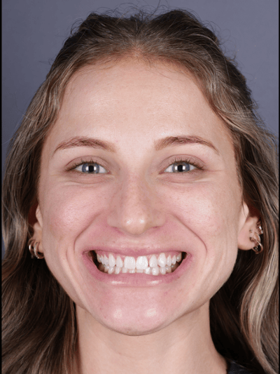 After treatment - Fixed Chipped Tooth with Composite Veneers