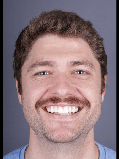 After treatment - Teeth Bleaching