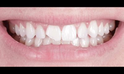 Before treatment - Fixed Chipped Tooth with Composite Veneers