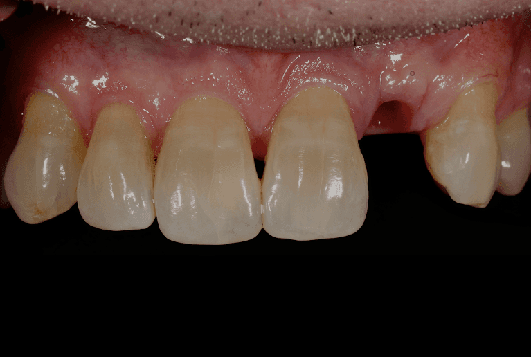 Implant-Crown-Before-Image