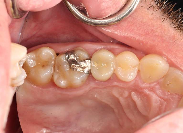 Onlay-Before-Image