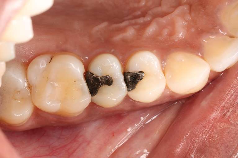 Onlay-Before-Image
