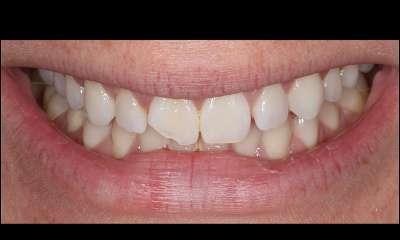 chipped tooth before veneers at talbert family dentistry