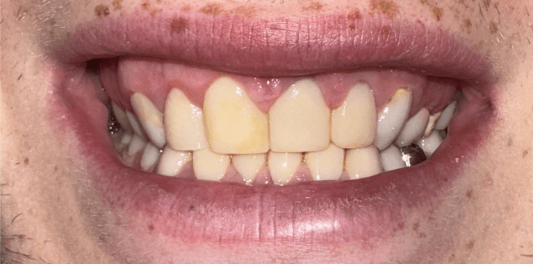 Veneers-Before-Image