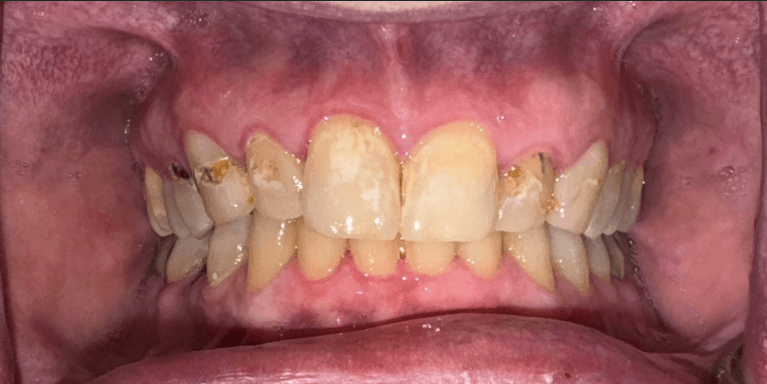 Veneers-Before-Image