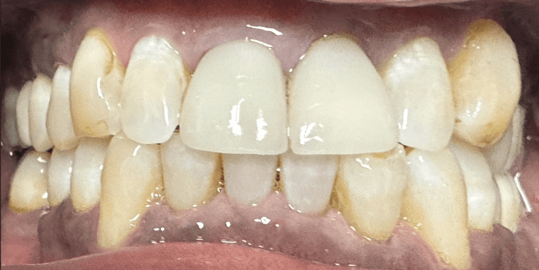 Veneers-Before-Image
