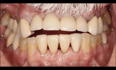 Before treatment - Before and After Broken Bridge