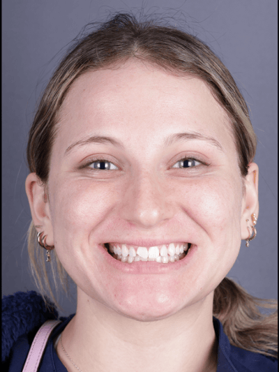 Before treatment - Fixed Chipped Tooth with Composite Veneers